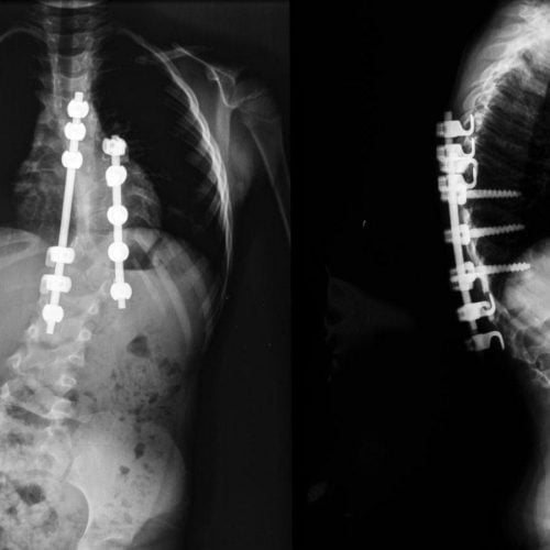 X-ray images showing spinal rods and screws used in scoliosis correction surgery.